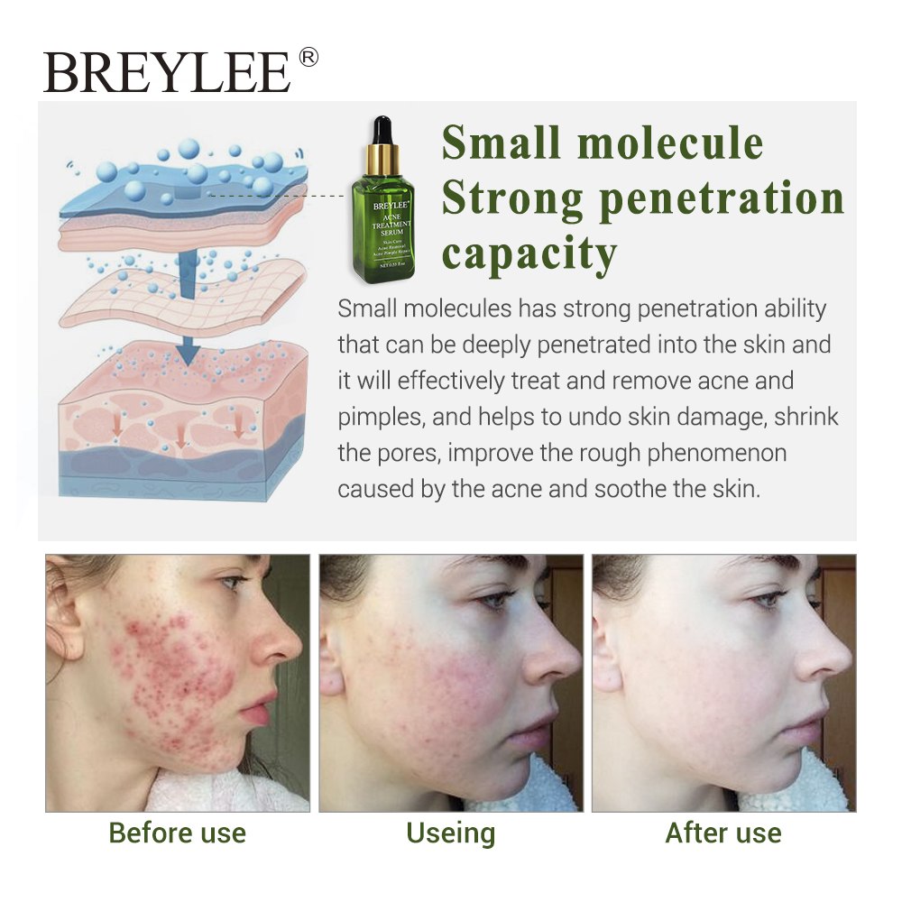 เซรั่มรักษาสิว BREYLEE | Acne Treatment Serum