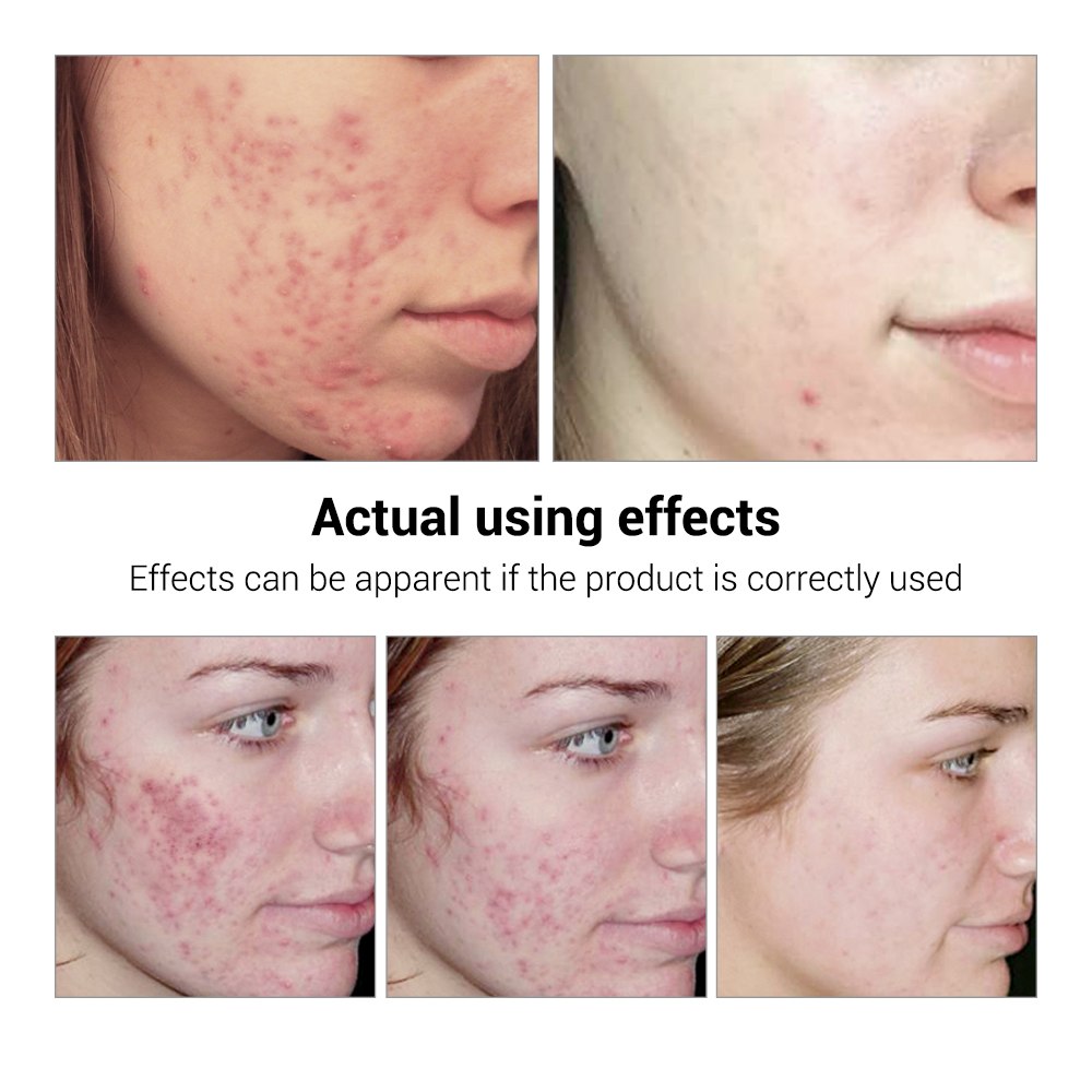 เซรั่มรักษาสิว BREYLEE | Acne Treatment Serum