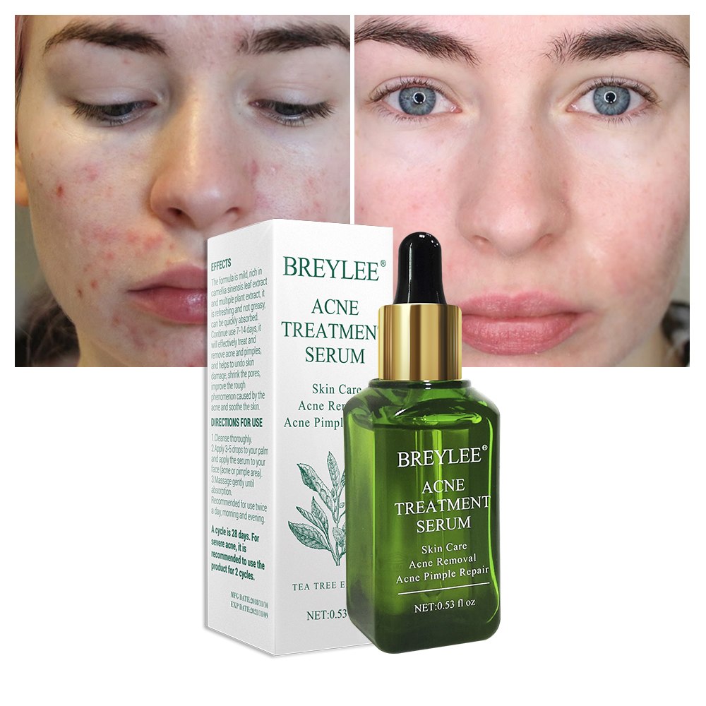 เซรั่มรักษาสิว BREYLEE | Acne Treatment Serum